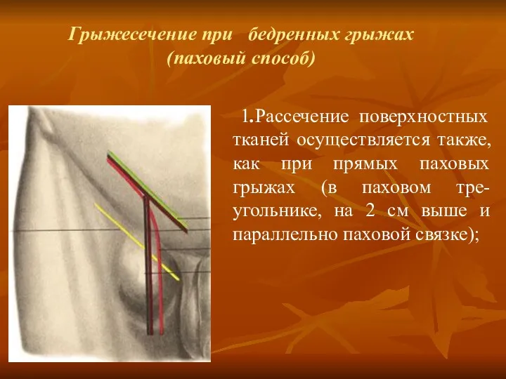 Грыжесечение при бедренных грыжах (паховый способ) 1.Рассечение поверхностных тканей осуществляется также, как при