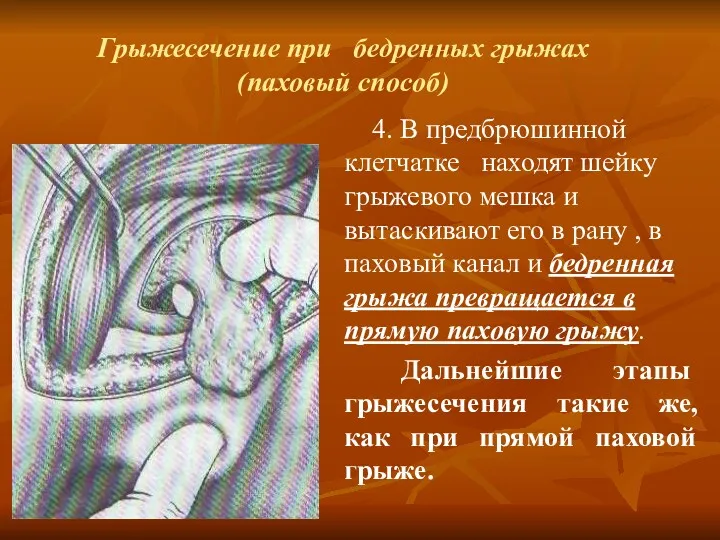 Грыжесечение при бедренных грыжах (паховый способ) 4. В предбрюшинной клетчатке