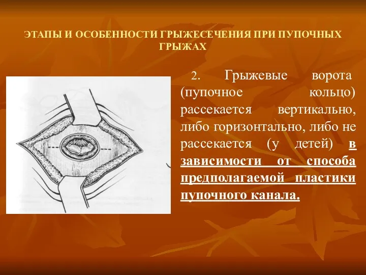 ЭТАПЫ И ОСОБЕННОСТИ ГРЫЖЕСЕЧЕНИЯ ПРИ ПУПОЧНЫХ ГРЫЖАХ 2. Грыжевые ворота