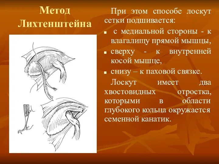 Метод Лихтенштейна При этом способе лоскут сетки подшивается: с медиальной