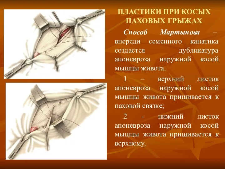 ПЛАСТИКИ ПРИ КОСЫХ ПАХОВЫХ ГРЫЖАХ Способ Мартынова – впереди семенного