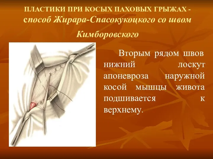 ПЛАСТИКИ ПРИ КОСЫХ ПАХОВЫХ ГРЫЖАХ - способ Жирара-Спасокукоцкого со швом Кимборовского Вторым рядом