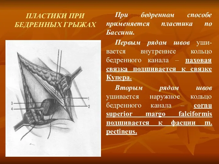 ПЛАСТИКИ ПРИ БЕДРЕННЫХ ГРЫЖАХ При бедренном способе применяется пластика по