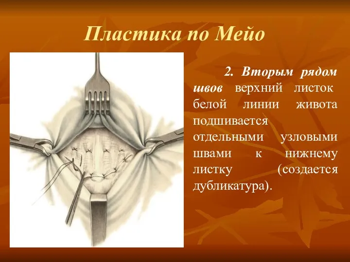 Пластика по Мейо 2. Вторым рядом швов верхний листок белой линии живота подшивается