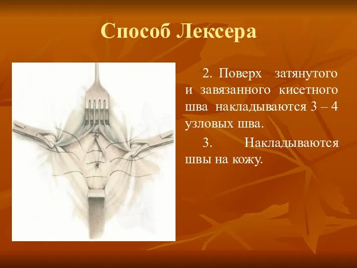 Способ Лексера 2. Поверх затянутого и завязанного кисетного шва накладываются 3 – 4