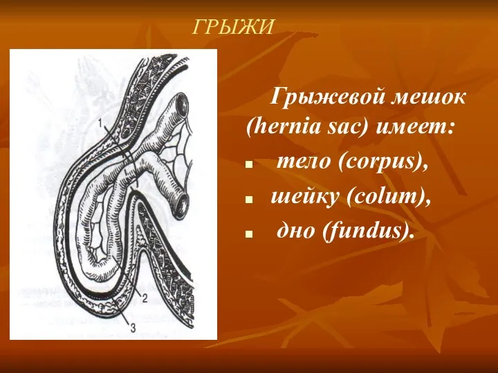 ГРЫЖИ Грыжевой мешок (hernia sac) имеет: тело (corpus), шейку (colum), дно (fundus).