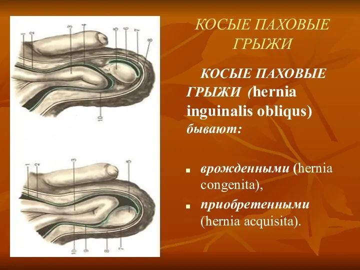 КОСЫЕ ПАХОВЫЕ ГРЫЖИ КОСЫЕ ПАХОВЫЕ ГРЫЖИ (hernia inguinalis obliqus) бывают: врожденными (hernia congenita), приобретенными (hernia acquisita).