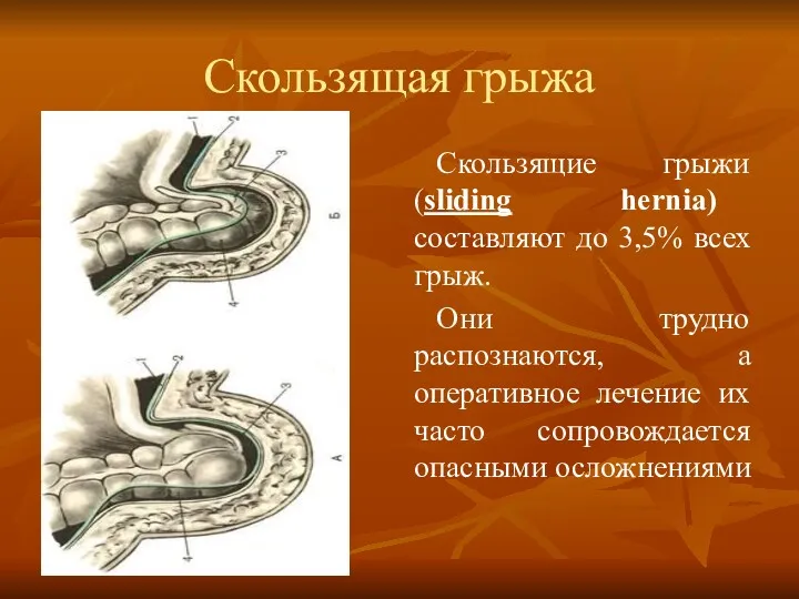 Скользящая грыжа Скользящие грыжи (sliding hernia) составляют до 3,5% всех грыж. Они трудно