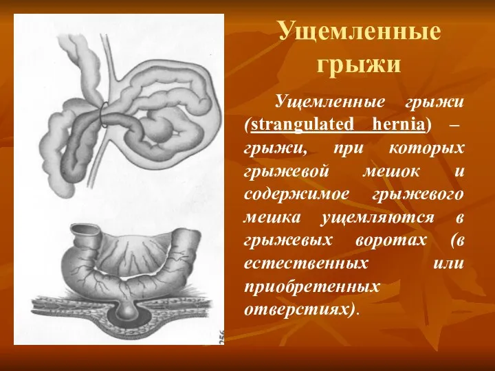 Ущемленные грыжи Ущемленные грыжи (strangulated hernia) – грыжи, при которых грыжевой мешок и