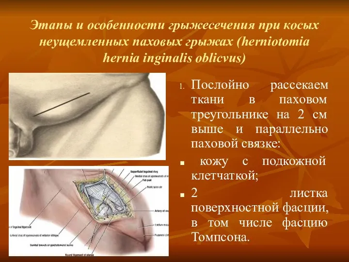Этапы и особенности грыжесечения при косых неущемленных паховых грыжах (herniotomia