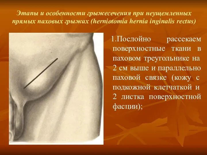 Этапы и особенности грыжесечения при неущемленных прямых паховых грыжах (herniotomia