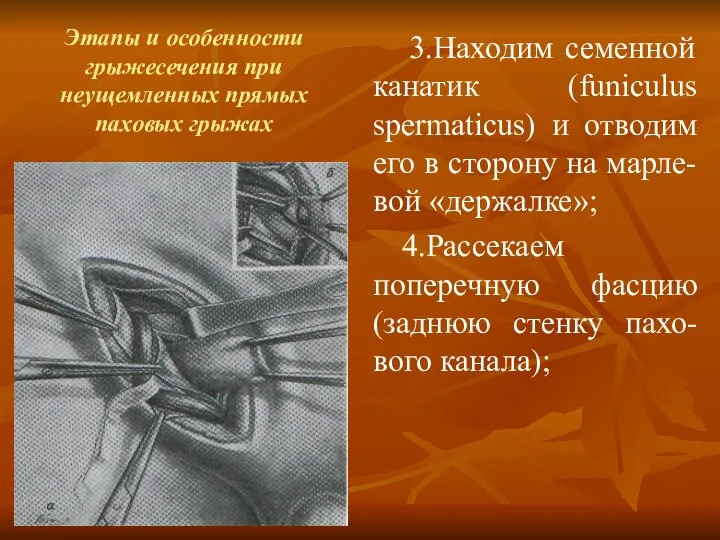 Этапы и особенности грыжесечения при неущемленных прямых паховых грыжах 3.Находим семенной канатик (funiculus