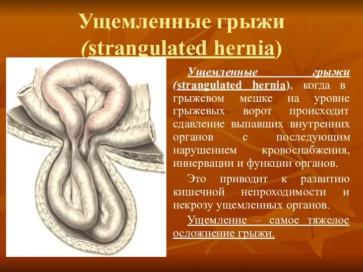 Ущемленные грыжи (strangulated hernia) Ущемленные грыжи (strangulated hernia), когда в грыжевом мешке на
