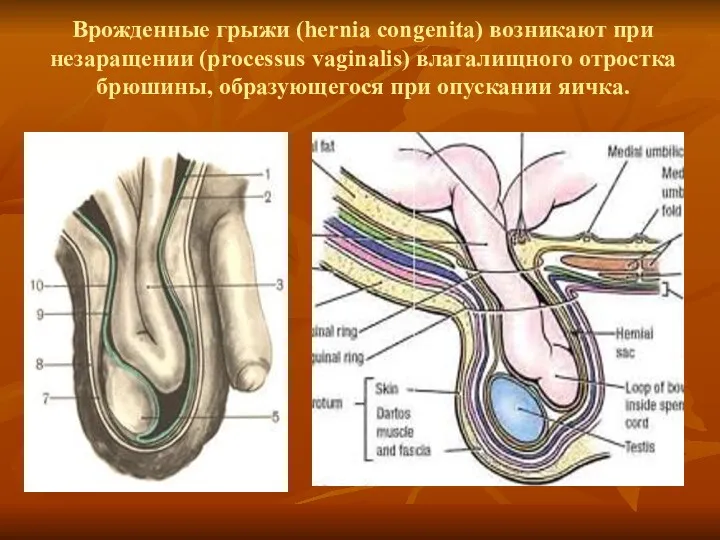 Врожденные грыжи (hernia congenita) возникают при незаращении (processus vaginalis) влагалищного отростка брюшины, образующегося при опускании яичка.