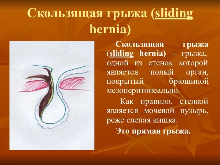 Скользящая грыжа (sliding hernia) Скользящая грыжа (sliding hernia) – грыжа,
