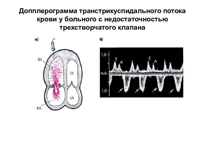 Допплерограмма транстрикуспидального потока крови у больного с недостаточностью трехстворчатого клапана