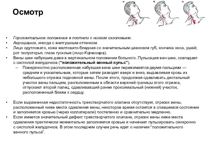 Осмотр Горизонтальное положение в постели с низким изголовьем. Акроцианоз, иногда