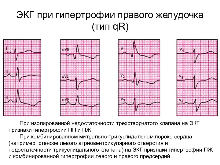 ЭКГ при гипертрофии правого желудочка (тип qR) При изолированной недостаточности