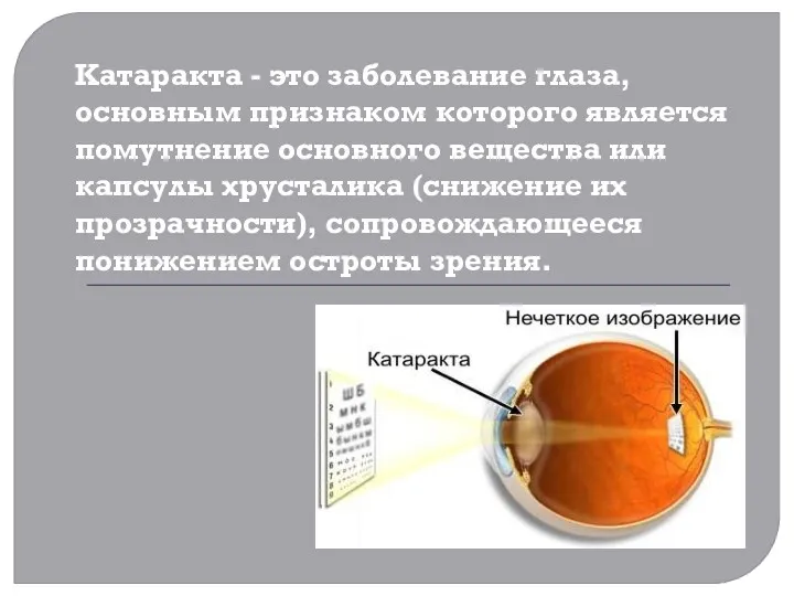 Катаракта - это заболевание глаза, основным признаком которого является помутнение