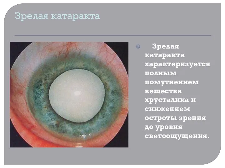 Зрелая катаракта Зрелая катаракта характеризуется полным помутнением вещества хрусталика и снижением остроты зрения до уровня светоощущения.