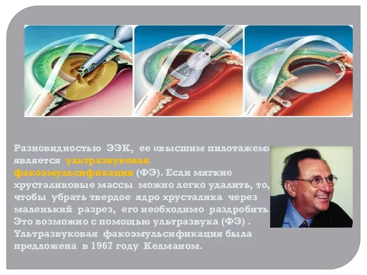 Разновидностью ЭЭК, ее «высшим пилотажем» является ультразвуковая факоэмульсификация (ФЭ). Если