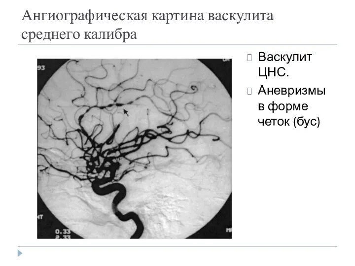 Ангиографическая картина васкулита среднего калибра Васкулит ЦНС. Аневризмы в форме четок (бус)