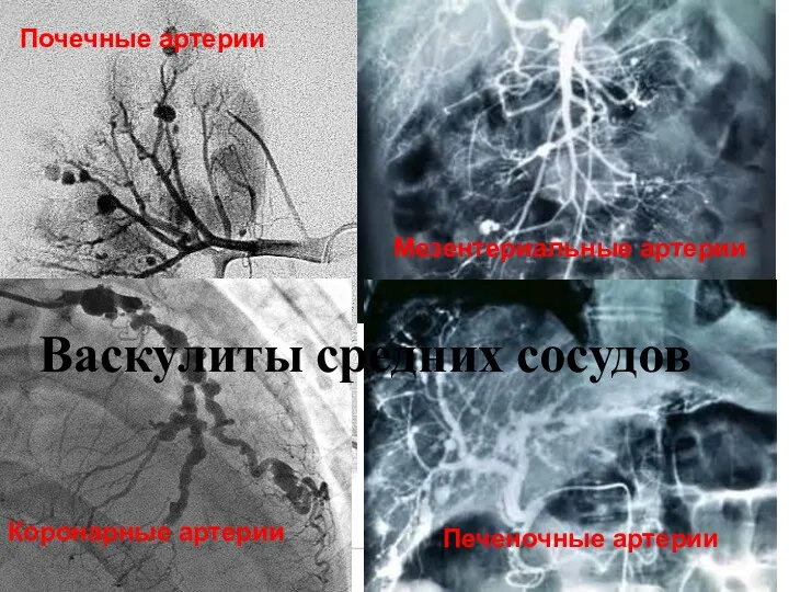 м Почечные артерии Коронарные артерии Мезентериальные артерии Васкулиты средних сосудов Печеночные артерии