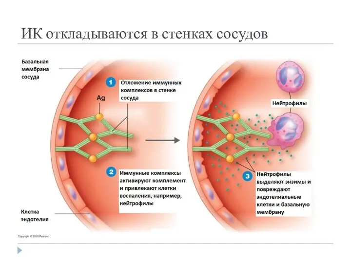 ИК откладываются в стенках сосудов