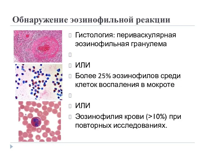 Обнаружение эозинофильной реакции Гистология: периваскулярная эозинофильная гранулема ИЛИ Более 25% эозинофилов среди клеток