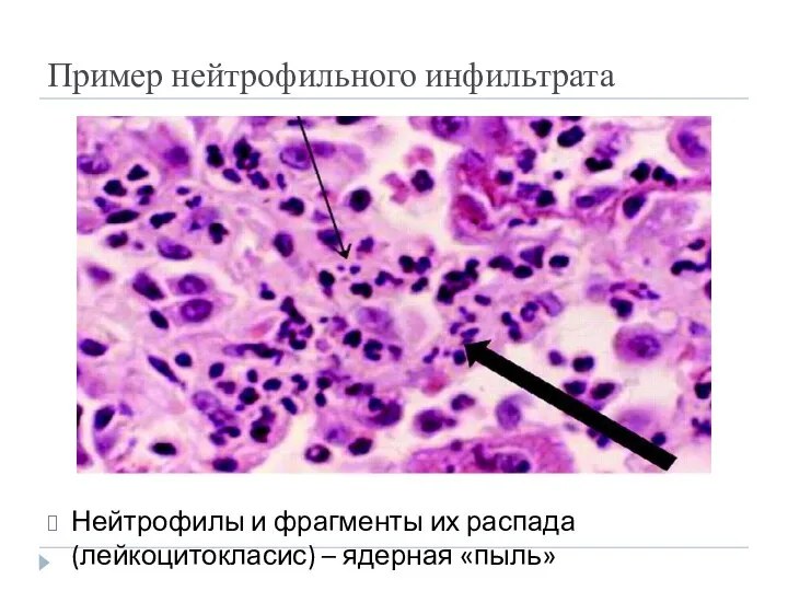 Пример нейтрофильного инфильтрата Нейтрофилы и фрагменты их распада (лейкоцитокласис) – ядерная «пыль»