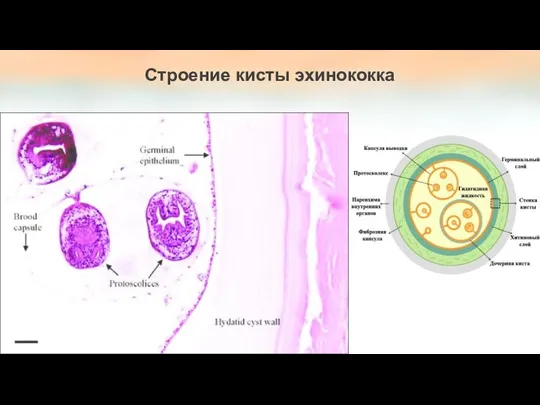 Строение кисты эхинококка