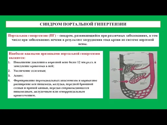 СИНДРОМ ПОРТАЛЬНОЙ ГИПЕРТЕНЗИИ Портальная гипертензия (ПГ) – синдром, развивающийся при