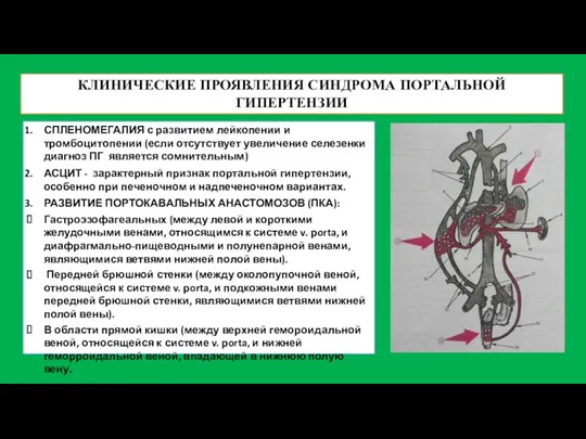 КЛИНИЧЕСКИЕ ПРОЯВЛЕНИЯ СИНДРОМА ПОРТАЛЬНОЙ ГИПЕРТЕНЗИИ СПЛЕНОМЕГАЛИЯ с развитием лейкопении и