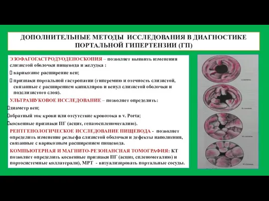 ДОПОЛНИТЕЛЬНЫЕ МЕТОДЫ ИССЛЕДОВАНИЯ В ДИАГНОСТИКЕ ПОРТАЛЬНОЙ ГИПЕРТЕНЗИИ (ГП) ЭЗОФАГОГАСТРОДУОДЕНОСКОПИЯ –