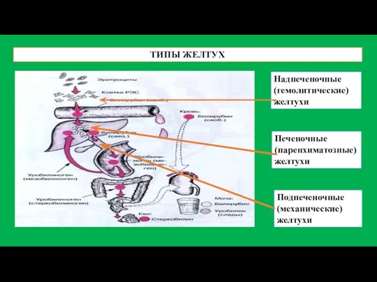 ТИПЫ ЖЕЛТУХ Надпеченочные (гемолитические) желтухи Печеночные (паренхиматозные) желтухи Подпеченочные (механические) желтухи