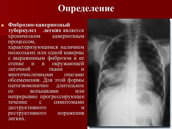 Определение Фиброзно-кавернозный туберкулез легких является хроническим кавернозным процессом, характеризующимся наличием