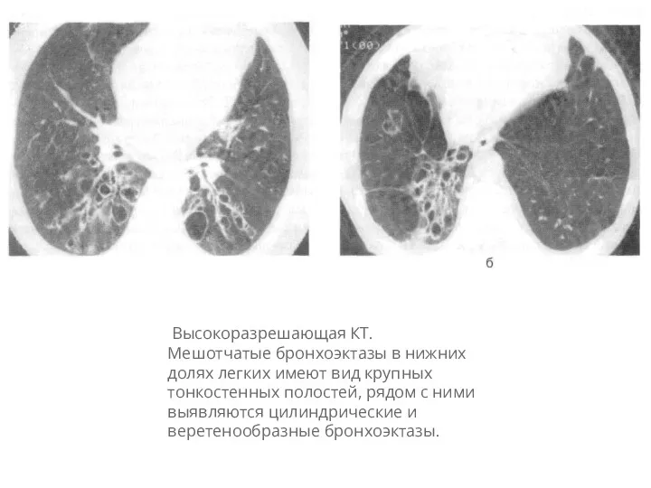 Высокоразрешающая КТ. Мешотчатые бронхоэктазы в нижних долях легких имеют вид