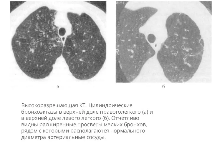 Высокоразрешающая КТ. Цилиндрические бронхоэктазы в верхней доле правоголегкого (а) и