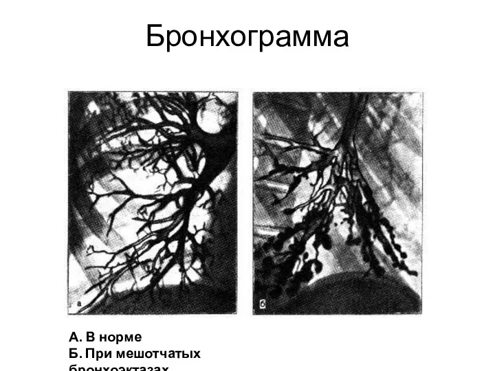 Бронхограмма А. В норме Б. При мешотчатых бронхоэктазах