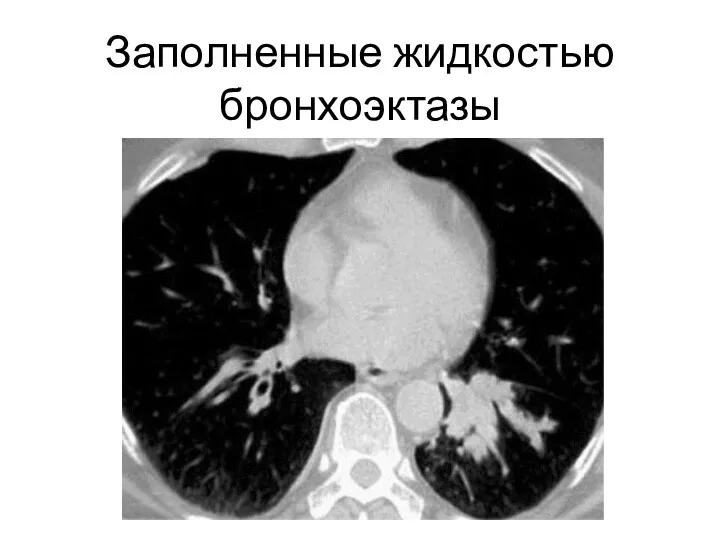 Заполненные жидкостью бронхоэктазы