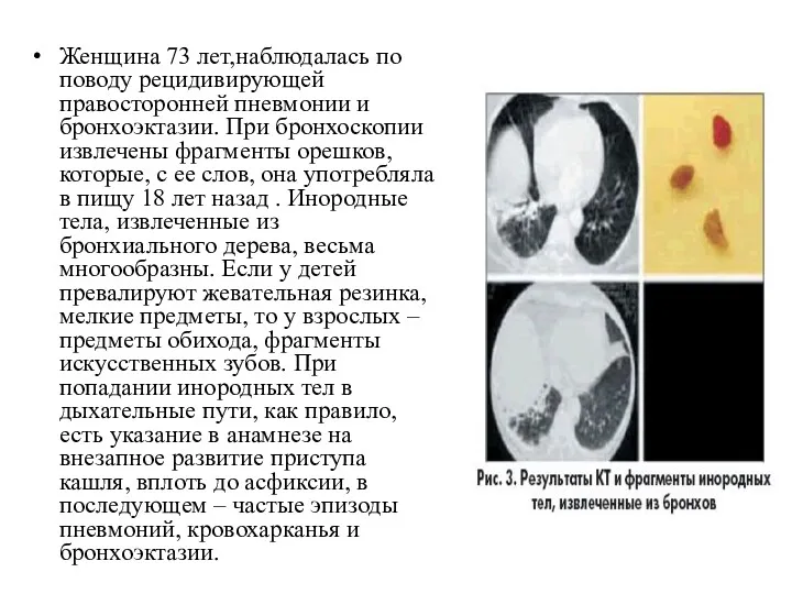 Женщина 73 лет,наблюдалась по поводу рецидивирующей правосторонней пневмонии и бронхоэктазии. При бронхоскопии извлечены