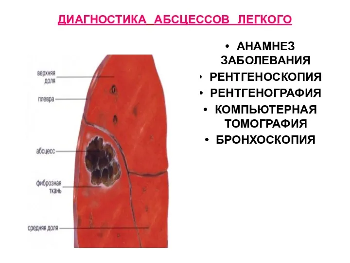 ДИАГНОСТИКА АБСЦЕССОВ ЛЕГКОГО АНАМНЕЗ ЗАБОЛЕВАНИЯ РЕНТГЕНОСКОПИЯ РЕНТГЕНОГРАФИЯ КОМПЬЮТЕРНАЯ ТОМОГРАФИЯ БРОНХОСКОПИЯ