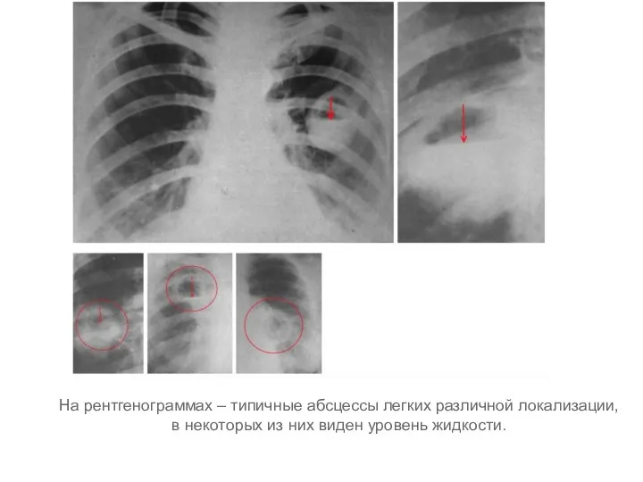 На рентгенограммах – типичные абсцессы легких различной локализации, в некоторых из них виден уровень жидкости.