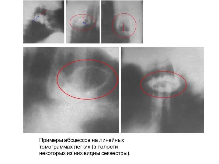 Примеры абсцессов на линейных томограммах легких (в полости некоторых из них видны секвестры).