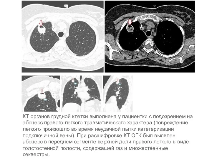 КТ органов грудной клетки выполнена у пациентки с подозрением на абсцесс правого легкого