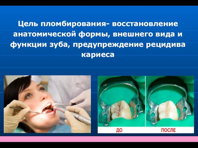 Цель пломбирования- восстановление анатомической формы, внешнего вида и функции зуба, предупреждение рецидива кариеса