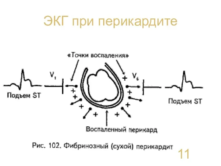 ЭКГ при перикардите