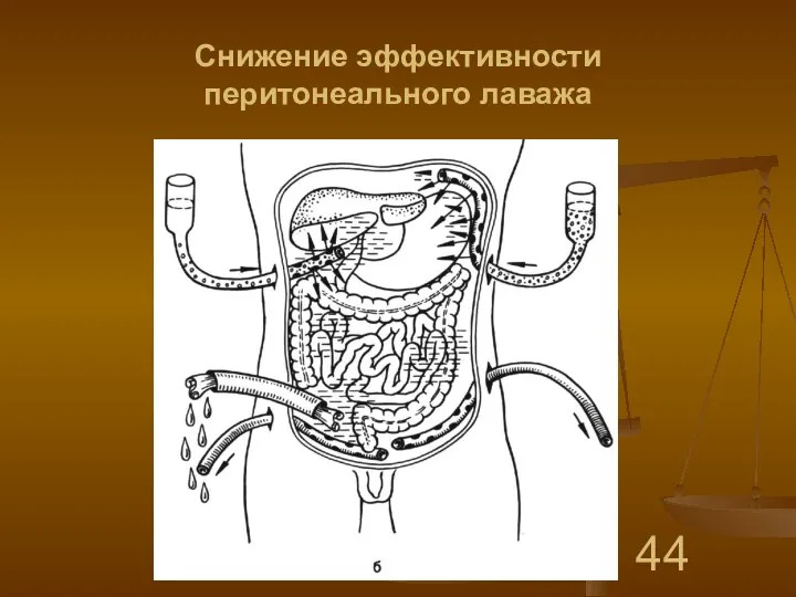 Снижение эффективности перитонеального лаважа