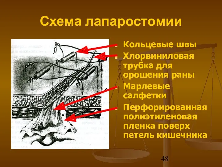 Схема лапаростомии Кольцевые швы Хлорвиниловая трубка для орошения раны Марлевые