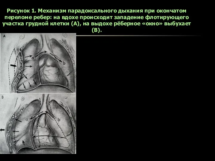 Рисунок 1. Механизм парадоксального дыхания при окончатом переломе ребер: на